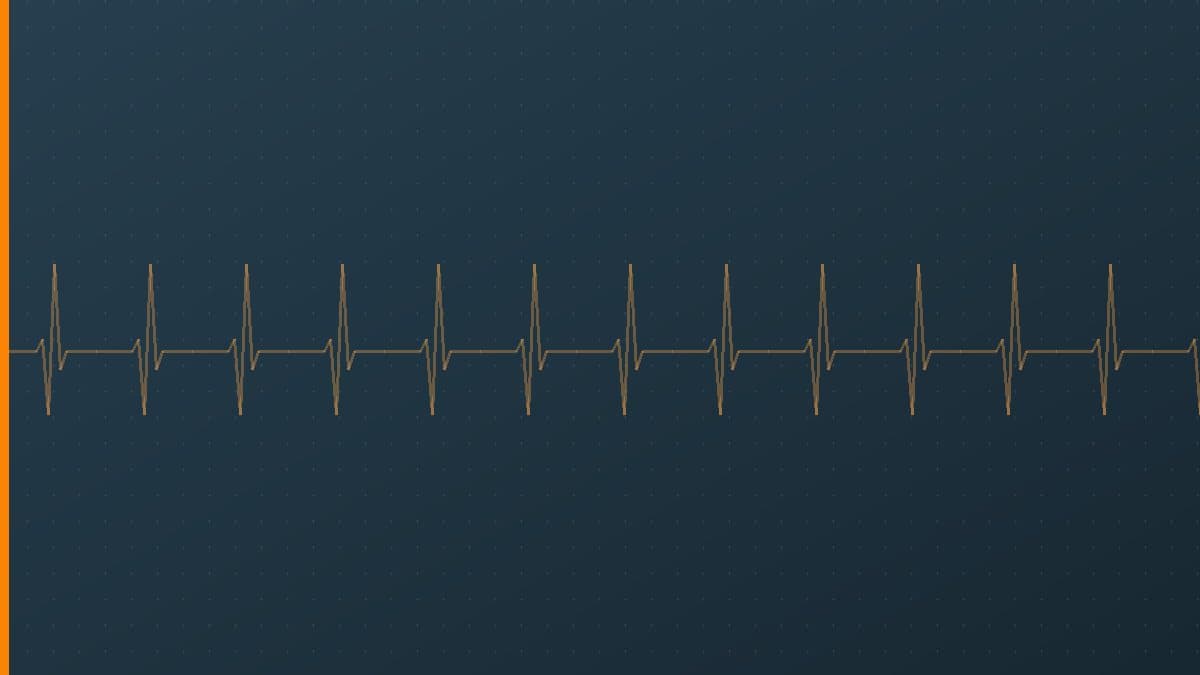 Wide Complex Tachycardia: The Life-Threatening Rhythm Every Nurse Must Recognize Immediately